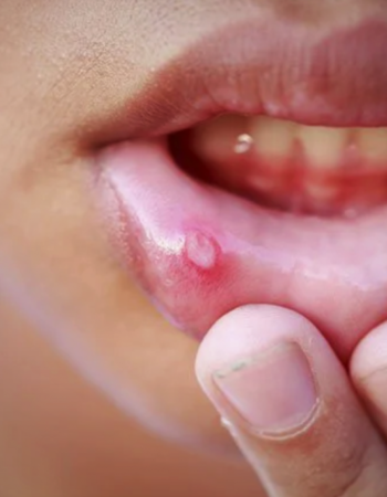 Lip Swelling After Dental Work